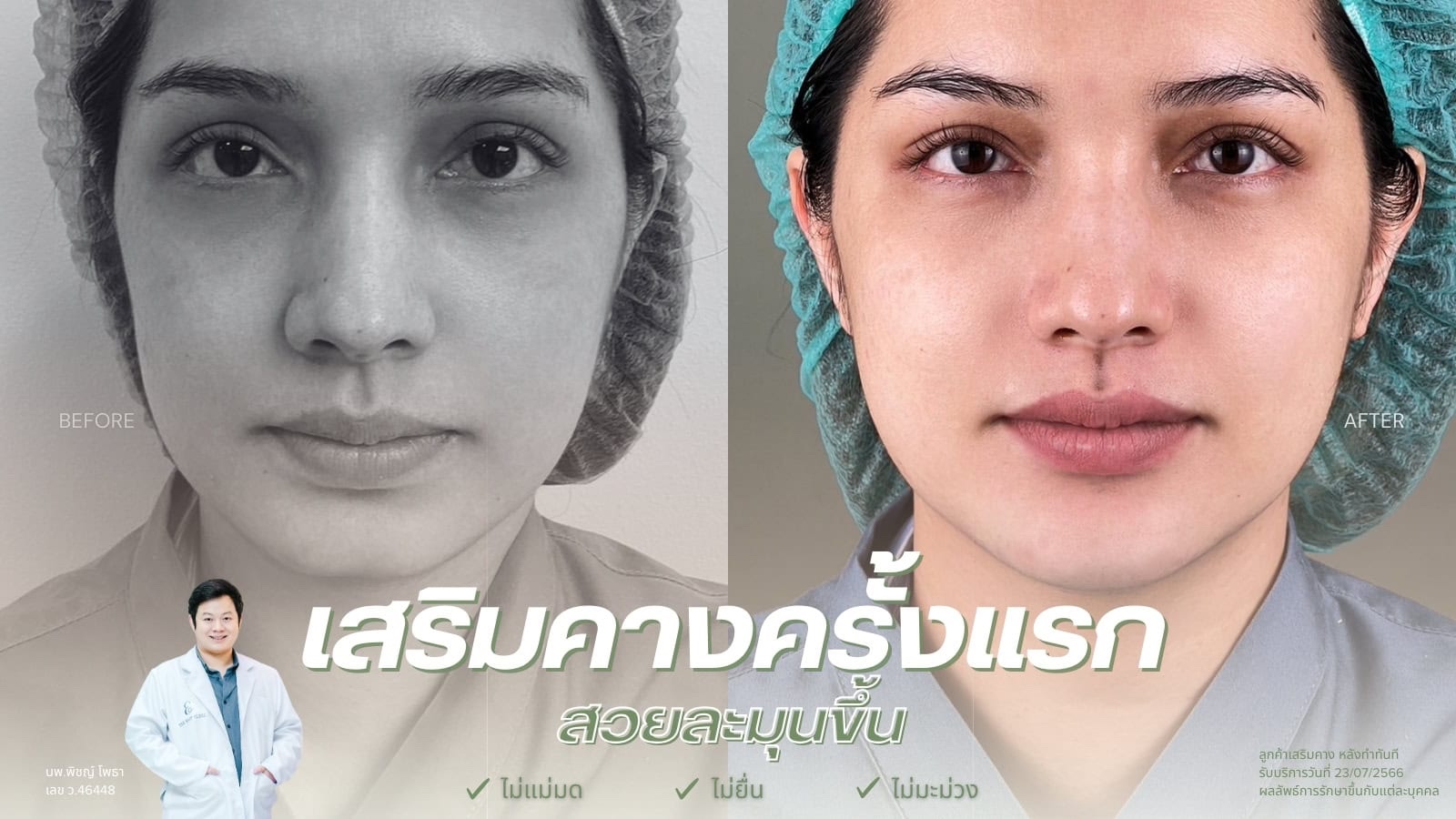 รีวิวเสริมคางแผลในครั้งแรกที่ The East Clinic