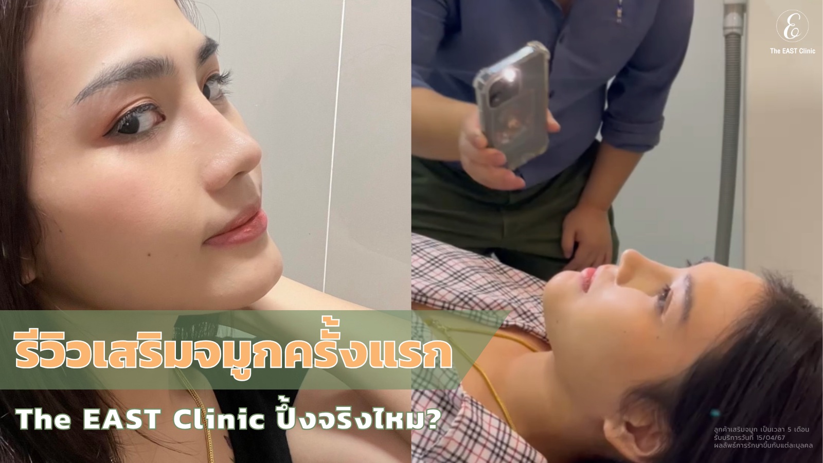 รีวิวเสริมจมูกครั้งแรกที่ The East Clinic