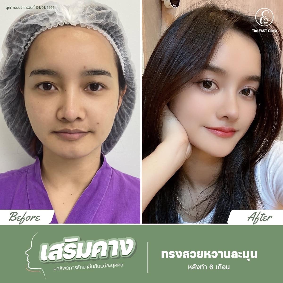 ภาพก่อนและหลังเสริมคางที่ ดิ อิสต์ คลินิก