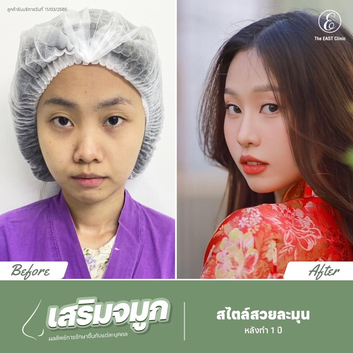 ภาพก่อนและหลังเสริมจมูกที่ ดิ อิสต์ คลินิก